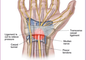 transverse carpal ligament Archives - The Lauterstein-Conway Massage School